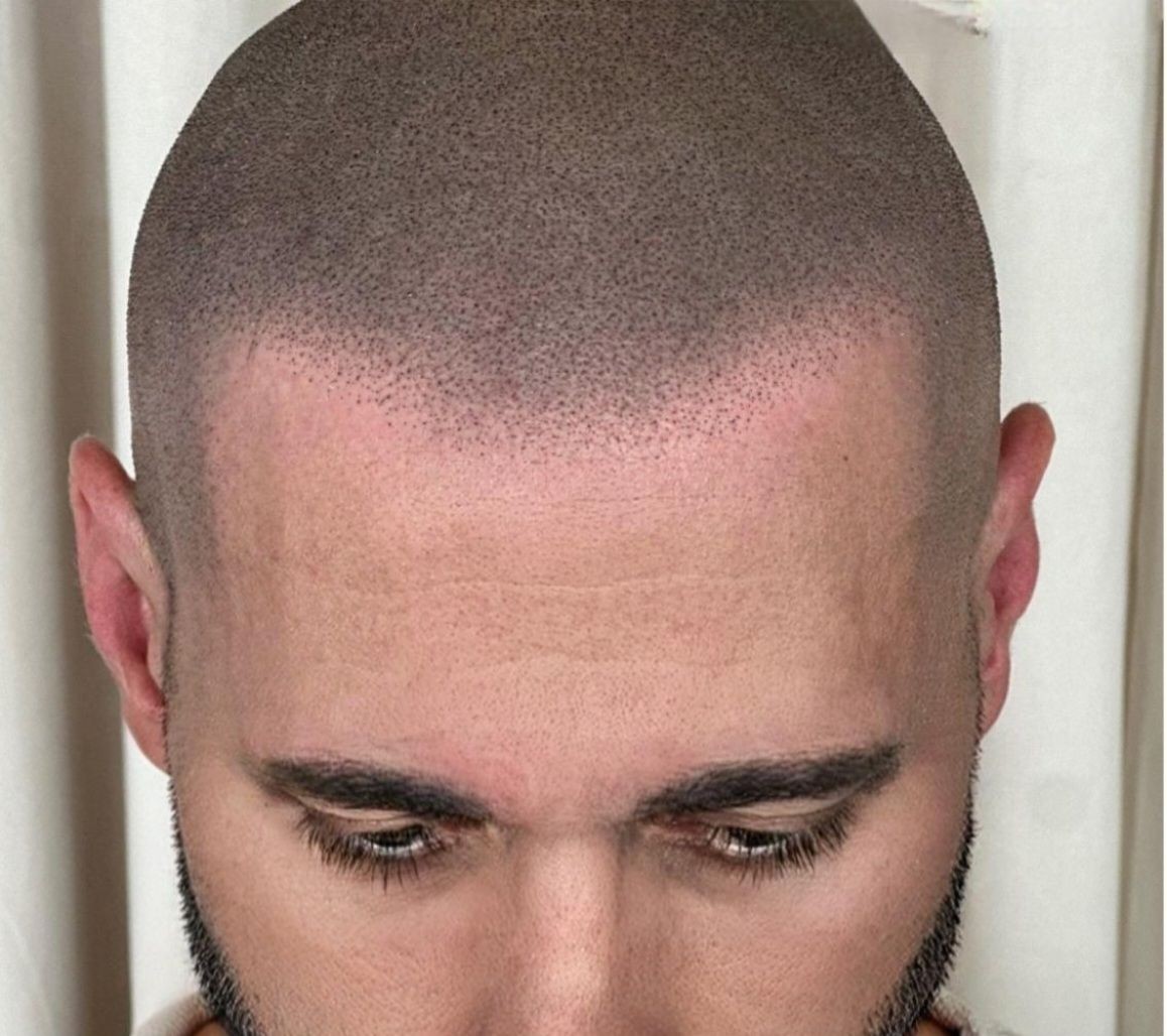 Close-up view of a man's head showing the results of a scalp micropigmentation treatment.