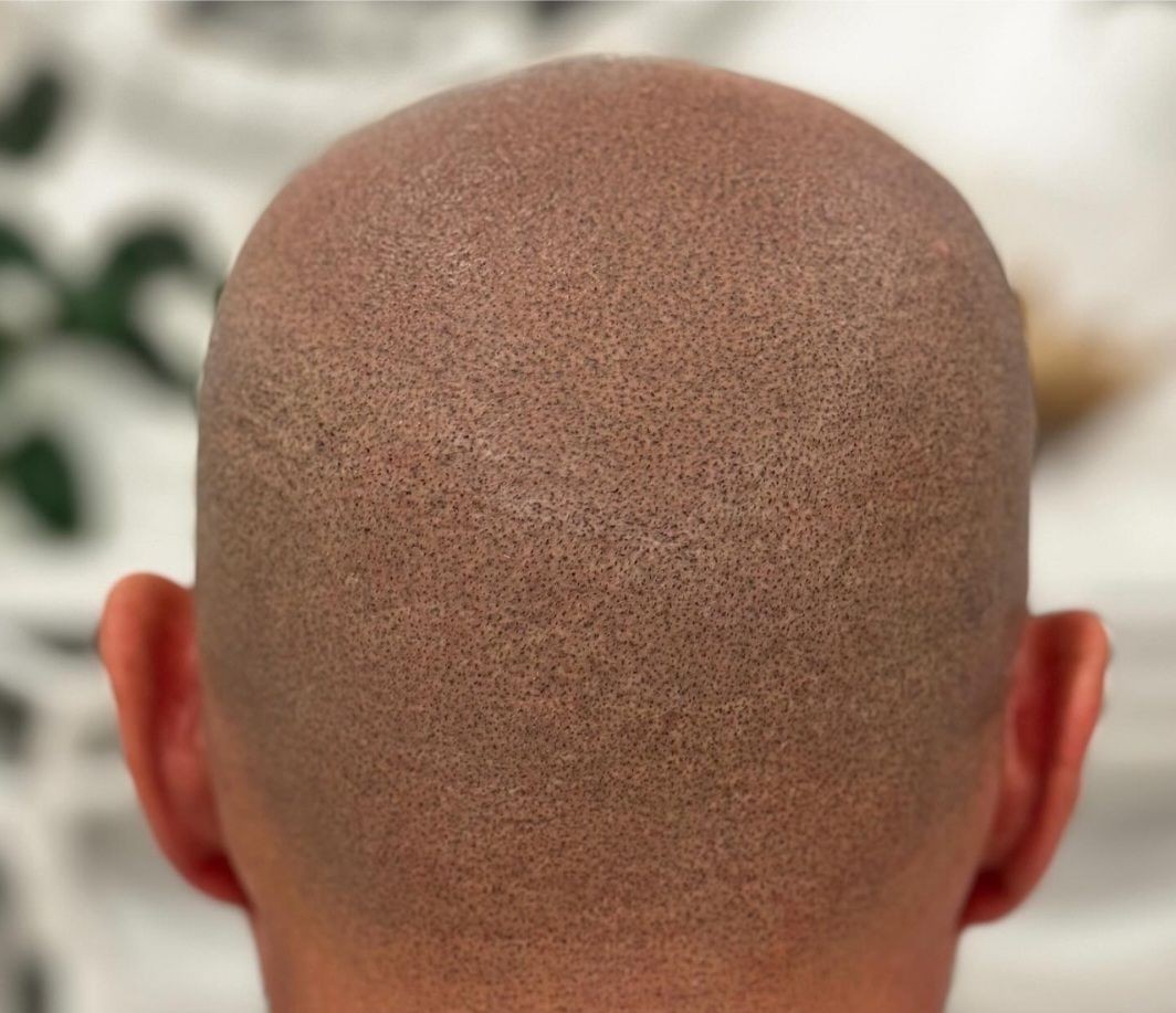 Close-up view of the back of a person's closely shaved head with fine hair stubble.